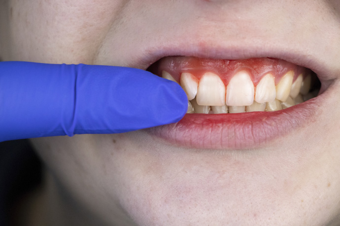 Dentista revisa encías que sangran